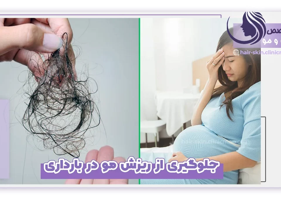 جلوگیری از ریزش مو در بارداری